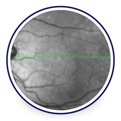 Optical Coherence Tomography